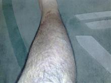 psoriasis leg after
